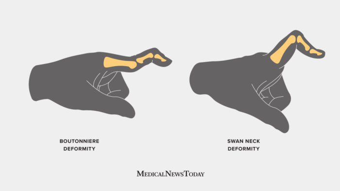 Boutonniere vs swan neck deformity