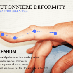 Boutonniere vs swan neck deformity