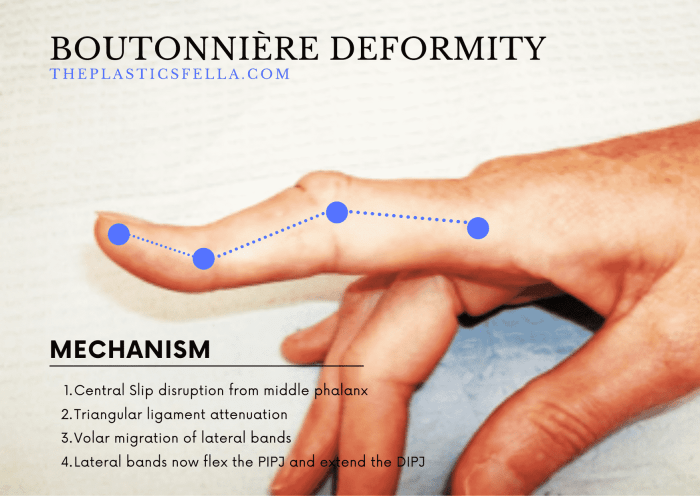 Boutonniere vs swan neck deformity