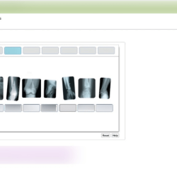 Drag the labels to identify types of fractures