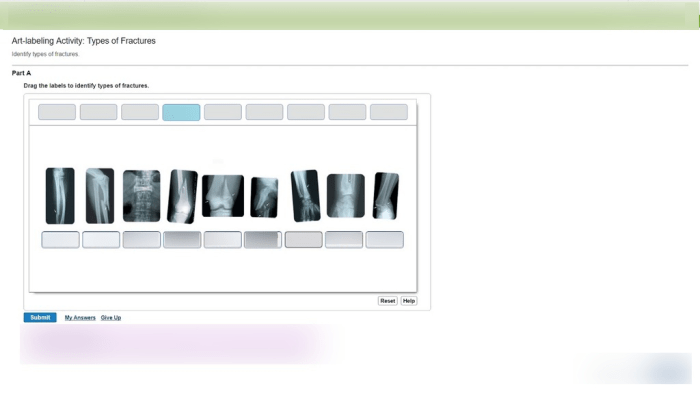 Drag the labels to identify types of fractures