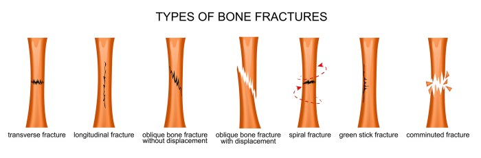 Drag the labels to identify types of fractures